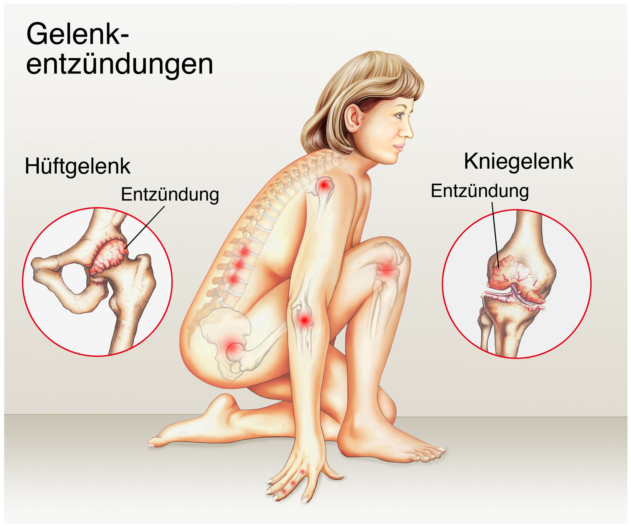 Kniende Frau.Gelenkentzündung Kniende Frau.Gelenkentzündung